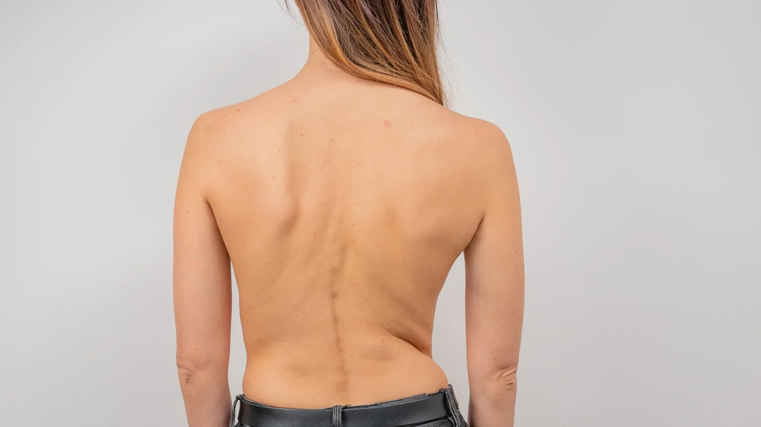 scoliosis